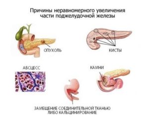 Увеличенная печень и поджелудочная железа