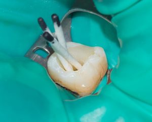 Непроходимость зубного канала
