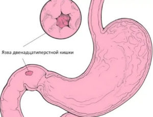 Лечение при язве двенадцатиперстной кишки