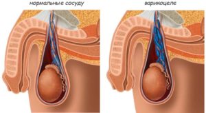 Возникновение варикоцеле от мастурбации