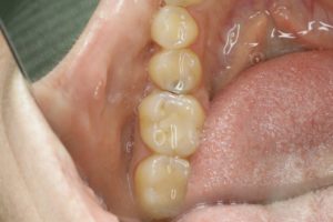 Ноет зуб после лечения кариеса