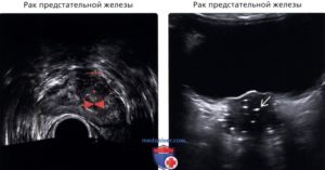 Гипоэхогенный узел простаты