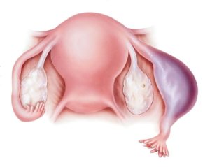 Воспаление яичников и задержка