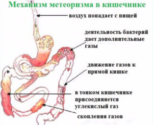 Вздутие и боль внизу животе. Газы отходят с трудом