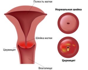 Половая жизнь при лечении цервицита