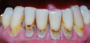 Зубной камень или кариес