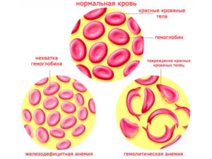 Гемолитическая болезнь новорожденных, низкий уровень гемоглобина и нейтрофилов в крови