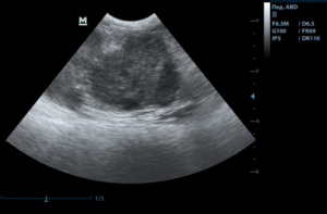 Увеличенная селезенка по УЗИ