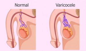 Возникновение варикоцеле от мастурбации