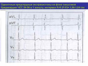 Экстрасистолия на фоне брадикардии