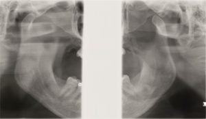 Белое пятно на рентгене челюстного сустава