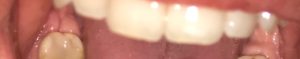Белое пятно на десне после удаления зуба