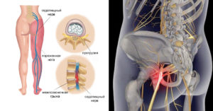 Межпозвоночная грыжа, боли в ноге