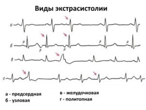 Как победить экстрасистолию?