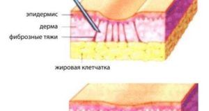 Танталовые швы и фиброзный тяж