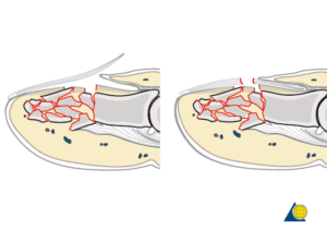 Перелом бугристости ногтевой фаланги