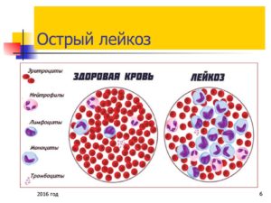 Острый лейкоз, тромбоцитопения