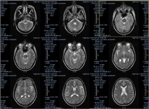 Расшифровка МРТ-снимка головного мозга