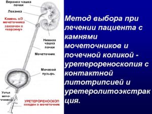 Камень в устье мочеточника