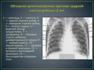 Расшифровка протокола рентгенографии грудной клетки