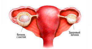 Боли в груди и киста левого яичника
