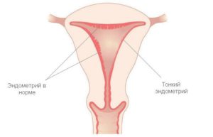 Возможна ли беременность при маленьком эндометрии