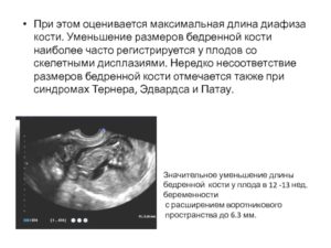 Дисплазия плода 2 триместр беременности