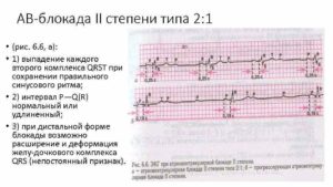 АВ блокады 2 ст. Тип 1 у ребенка, занимается спортом