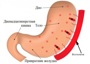 Воспалительные гиперпластические папулы в антральном отделе желудка