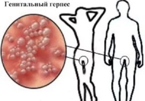Секс при генитальном герпесе