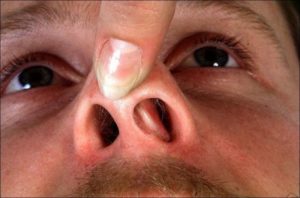 Воспаление носовой перегородки