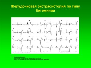 Частая желудочковая экстрасистолия по типу бигеминии