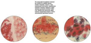 Воспалительный тип мазка на цитологию