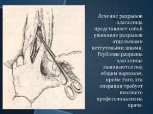Разрыв влагалища