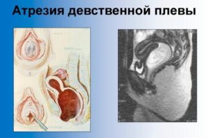 Как может растянутся девственная плева?