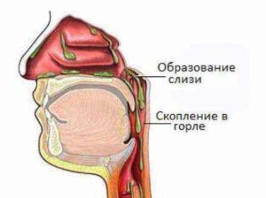 Мучеет скопление белой слизи на задней стенке горло