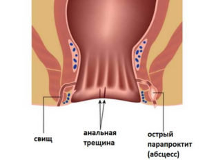 Анальная трещина у грудничка