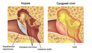 Двусторонняя дисфункция слуховых труб