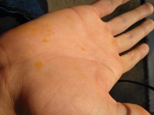 Желтое пятно на руке