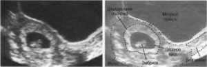 Беременность. Нечеткие неровные контуры эмбриона