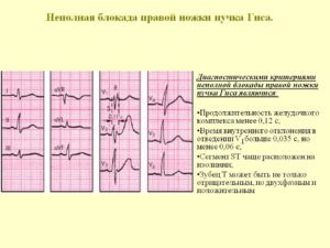 Замедление проведения хода возбуждения по правой ножке пучка Гиса