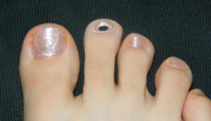 Чёрные точки на ногте на ноге