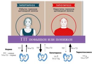 Уровень ТТГ, увеличенная щитовидка