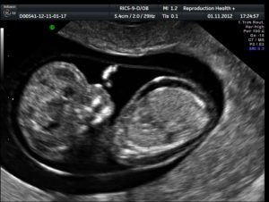 На 20 неделе беременности генерализованный отек и анемия у плода