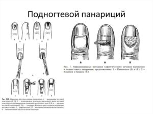 Удалили ноготь - подногтевой панариций