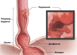 Царапина пищевода?