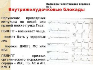 Замедление проведения хода возбуждения по правой ножке пучка Гиса