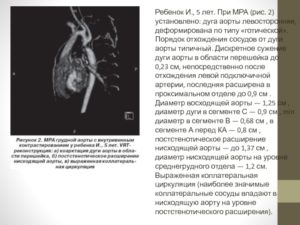 Дилатация восходящей аорты у ребенка