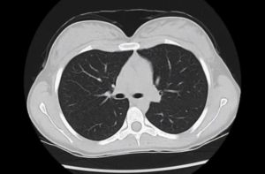 Результаты МСКТ легких