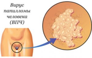 Кондиломы или микропапилломатоз